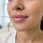 lip flip botox avant après