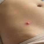 bouton sur le pubis femme