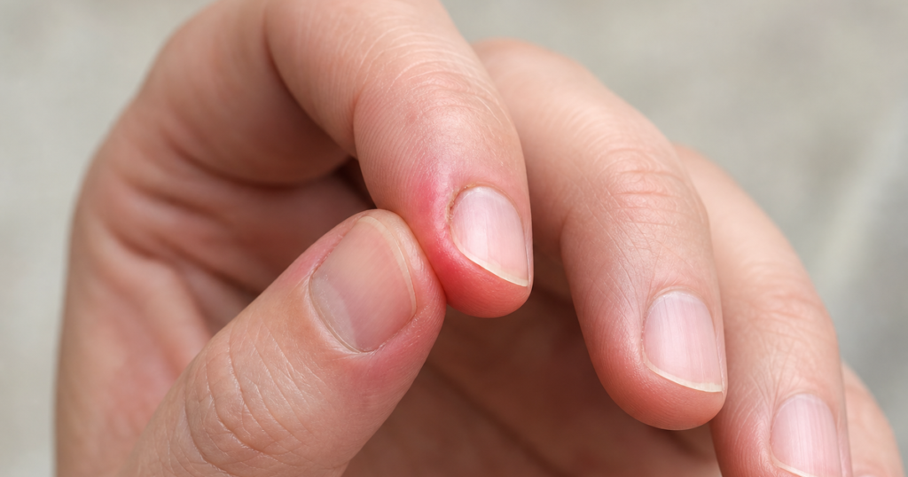 ongle incarné main