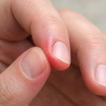 ongle incarné main
