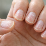 taches blanches sur les ongles